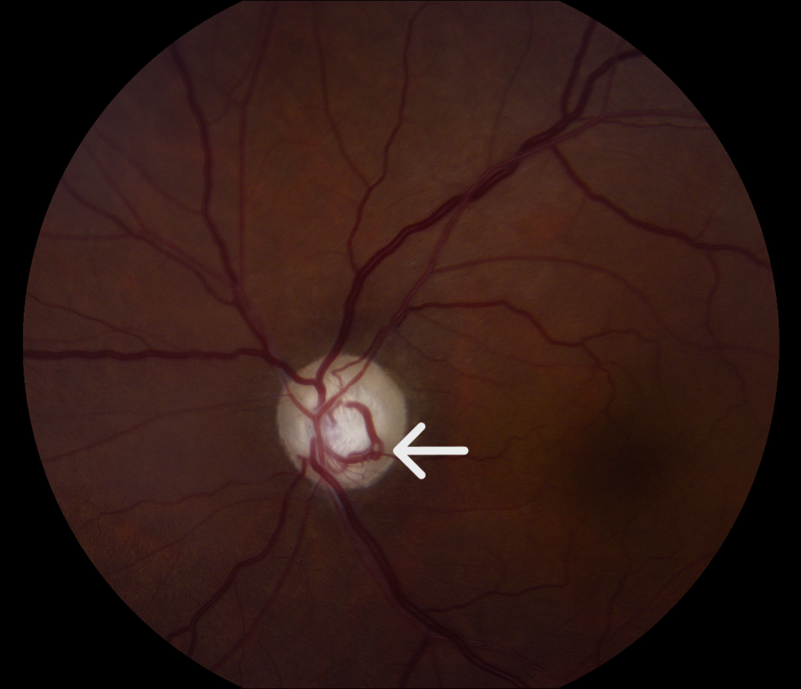Fundus photo of the left eye showing large optic discs with large deep cups, neuroretinal rim pallor, and optociliary shunt vessels (white arrow) 